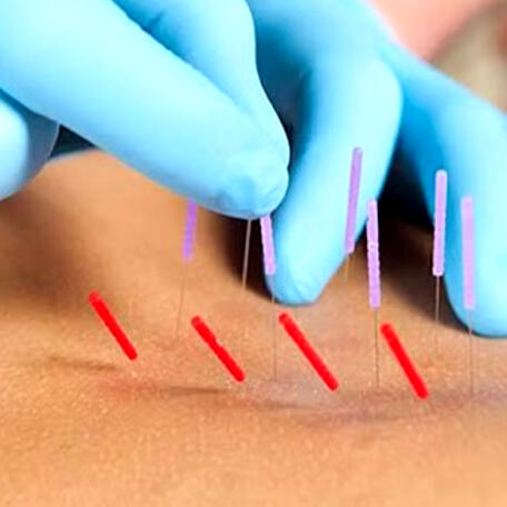 Dry Needling